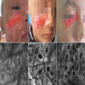 北京北苑白癜风研究院 TYR基因调控祛白体系 开创祛白新纪元