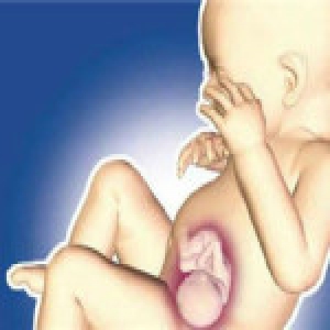 新生儿腹中现寄生胎 出生11天后接受“剖腹产”