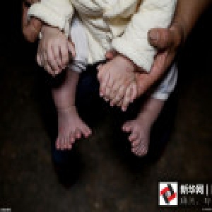 广西男婴两手各多一个肉手指 没有骨头与小指长度一样