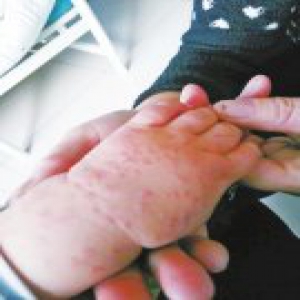 医生使用两年前禁药 1岁半男童输完液浑身起疙瘩