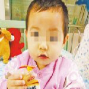 女童吃饭时筷子插进左眼长约5厘米 医生手术取出