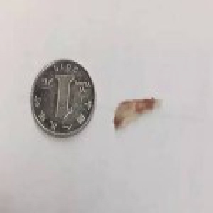 因食道卡着一根鱼刺 女子花6000元做全麻手术