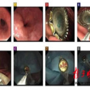 男子喝酒太猛吞下瓶盖 医生借避孕套将盖子取出